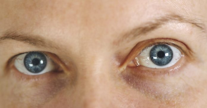 glaucoma glaucoma