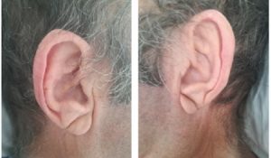 Pieghe sui lobi delle orecchie e altri sintomi di malattie cardiache che non vanno ignorati