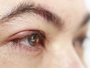 Dermatomyositis