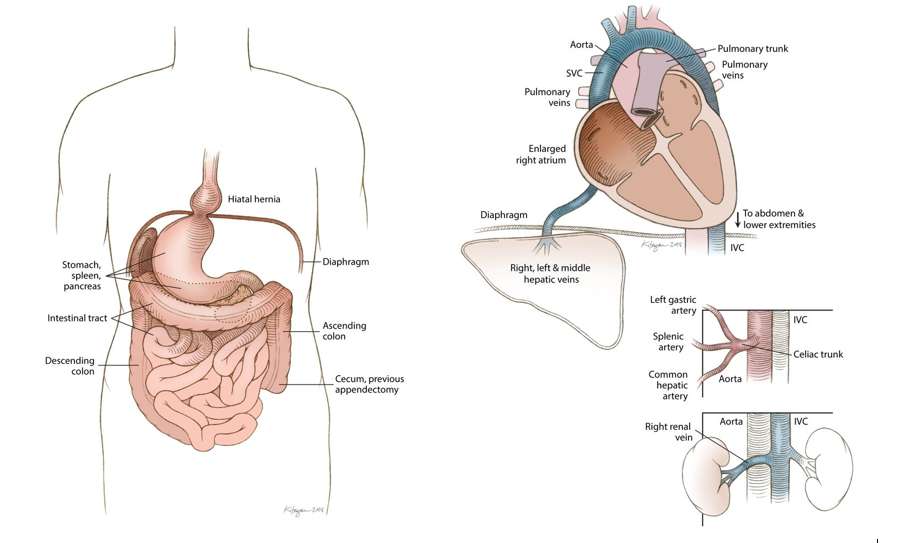 99enne ha vissuto tutta la vita con gli organi nella parte sbagliata (e non lo sapeva)