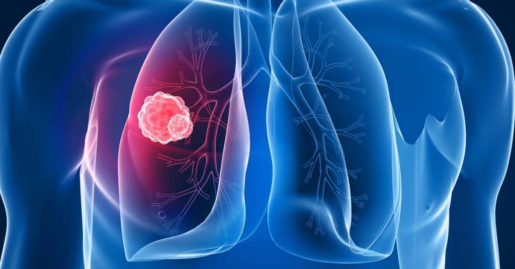 Cancro ai polmoni: quando è il momento di preoccuparsi? Sintomi e colore del muco