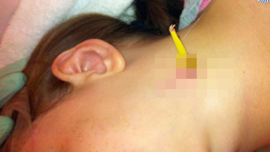 11enne finisce in ospedale per una matita conficcata in gola