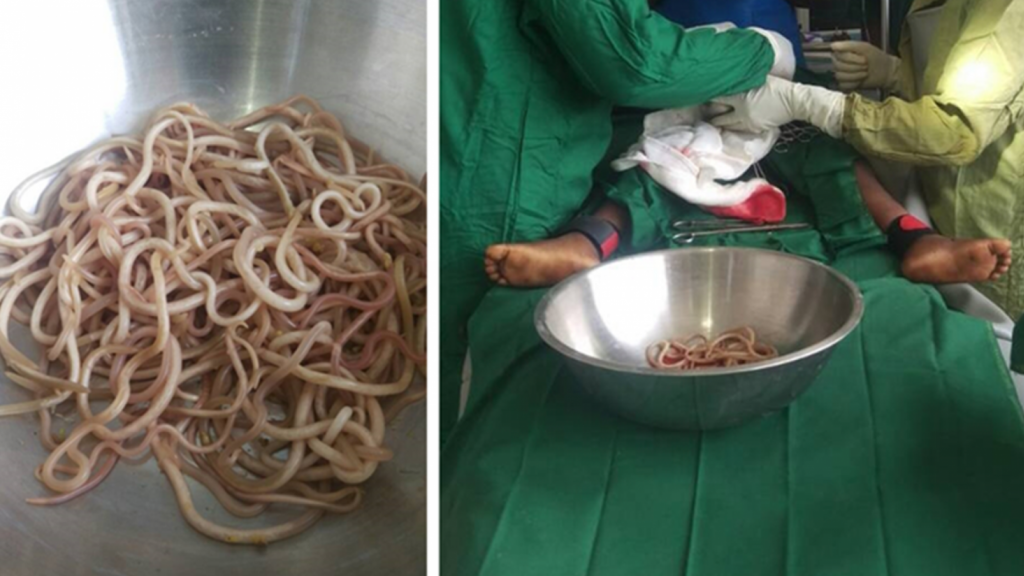 Bimbo di 4 anni aveva dozzine di vermi nell'intestino