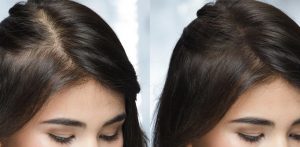 Perché le donne perdono i capelli? 7 segni spesso ignorati dell'alopecia