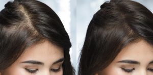 Perché le donne perdono i capelli? 7 segni spesso ignorati dell’alopecia