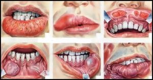 Cancro alla bocca: sintomi, cause, rimedi naturali e prevenzione