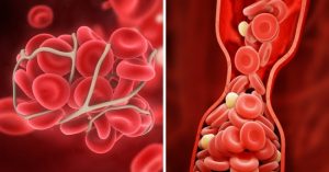 8 consigli per evitare i coaguli di sangue (che possono essere molto pericolosi per la vita)