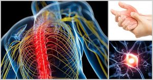 12 rimedi naturali per il dolore neuropatico (o nevralgia)