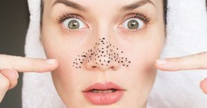 Cosa fare per rimuovere i pori nasali? Ecco qualche utile consiglio
