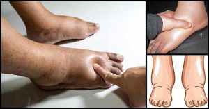 Le cause più comuni del gonfiore a gambe, caviglie e piedi