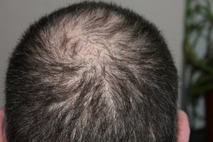 Come evitare la perdita dei capelli e quando bisogna preoccuparsi?