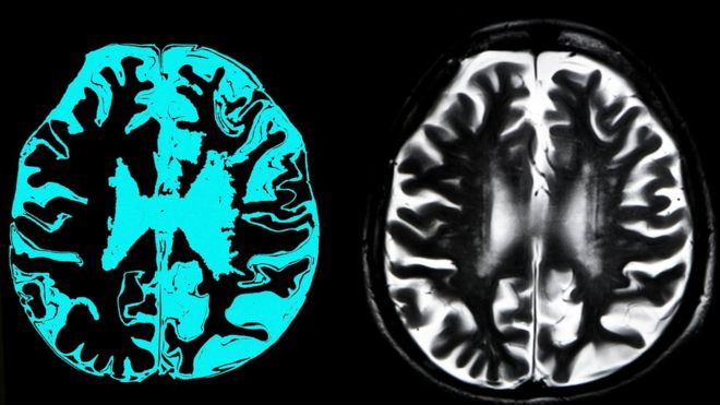 Scoperto un nuovo farmaco che può rallentare il morbo di Alzheimer