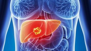 Cancro al fegato: tipi, cause, sintomi e prognosi