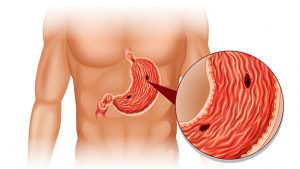 Ulcera gastrica: sintomi, fattori di rischio e quando vedere un medico