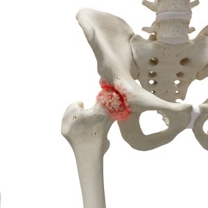 Dolore all’anca: quali sono le cause e come affrontarlo