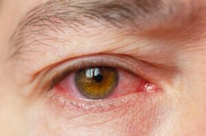Coronavirus: gli occhi arrossati possono essere un segno dell’infezione?