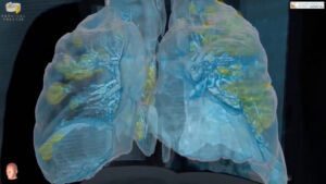 Come il coronavirus danneggia i polmoni, simulazione in 3D (VIDEO)