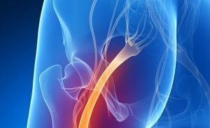 Sciatica: sintomi, trattamenti, rimedi