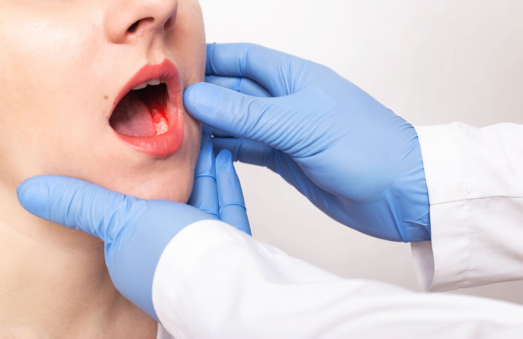 Cancro alla bocca: quali sono i 13 campanelli d’allarme?