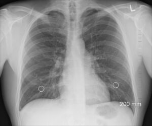 Enfisema: cos’è, cause, sintomi, trattamento