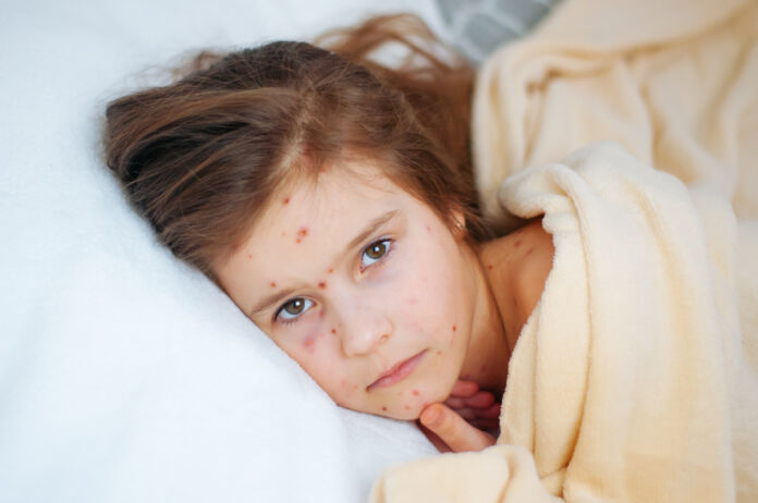 Closeup of cute sad little girl in bed. Varicella virus or Chickenpox bubble rash on child
