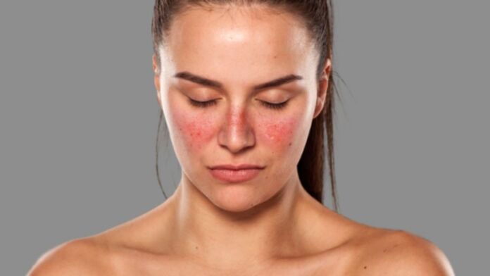 lupus