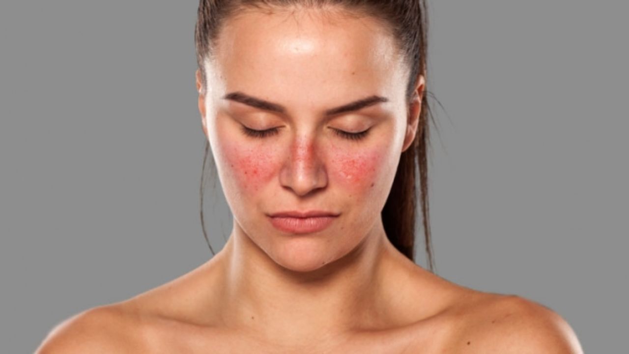 Lupus cos'è, sintomi, diagnosi, trattamento