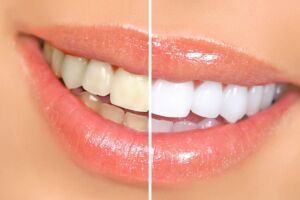 Vuoi che i tuoi denti siano di nuovo bianchi? Segui questi rimedi naturali