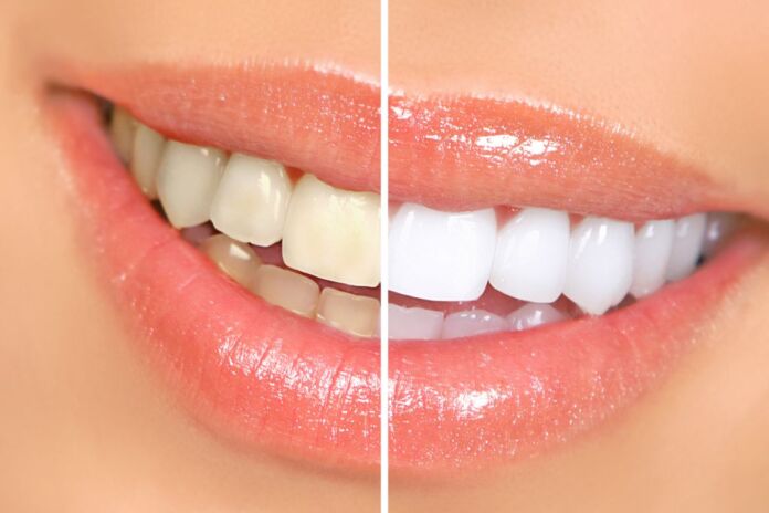 come sbiancare i denti in maniera naturale