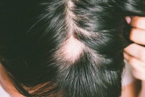 Alopecia: cos’è, cause, sintomi e trattamento
