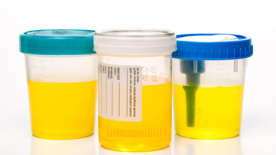 Proteinuria cos'è, sintomi, cause, trattamento
