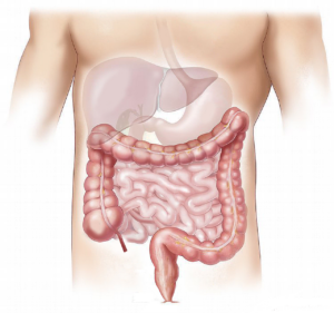 Sindrome dell’intestino corto: cos’è, sintomi, cause, trattamento