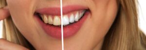 Sbiancamento dei denti, come farlo e quanto dura