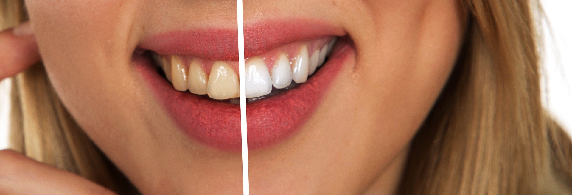 Sbiancamento dei denti, come farlo e quanto dura Sbiancamento dei denti, come farlo e quanto dura
