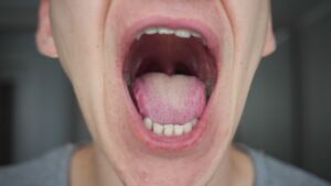 Le lesioni sulla bocca sono un altro sintomo del Covid-19?