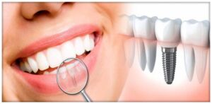 Impianti dentali: la loro manutenzione è fondamentale, ecco perché