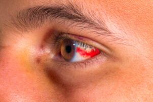 Macchie rosse sugli occhi: cause e quando preoccuparsi