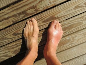 Piedi e caviglie gonfi: quali sono le cause? Quando preoccuparsi?