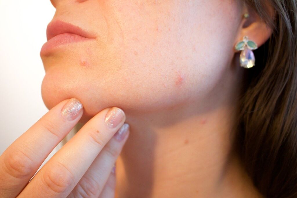 Acne: cos’è, cause, tipologie e trattamento