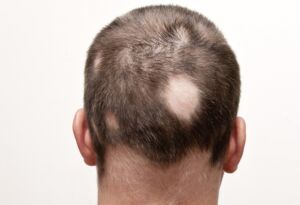 alopecia sintomi cause