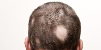 alopecia sintomi cause