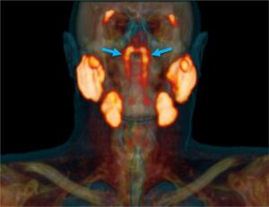 Scoperto un nuovo organo nel cranio umano