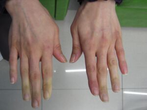 Quali sono le cause delle mani scolorite?