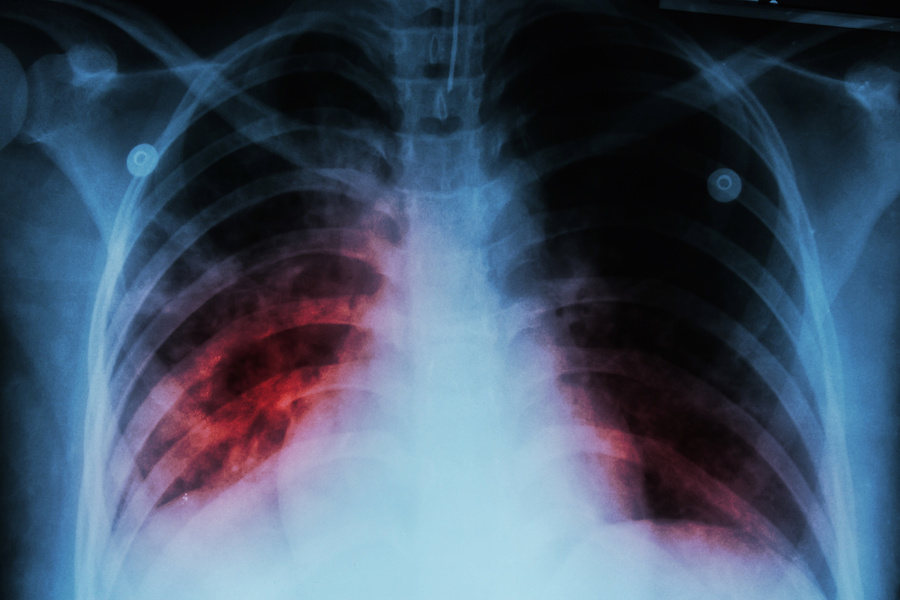 Tubercolosi: cos’è, sintomi, organi colpiti, diagnosi e cura