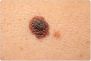 Melanoma cutaneo: cos’è, prevenzione, sintomi, cause, diagnosi