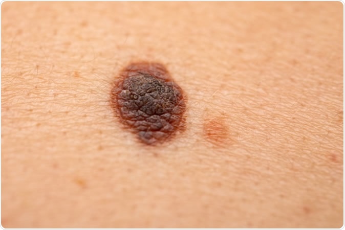 melanoma