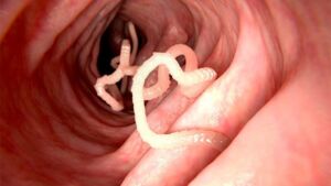 Cosa mangiare per eliminare i vermi intestinali? I 5 alimenti