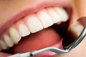 Come prevenire la carie dentale? Semplici consigli