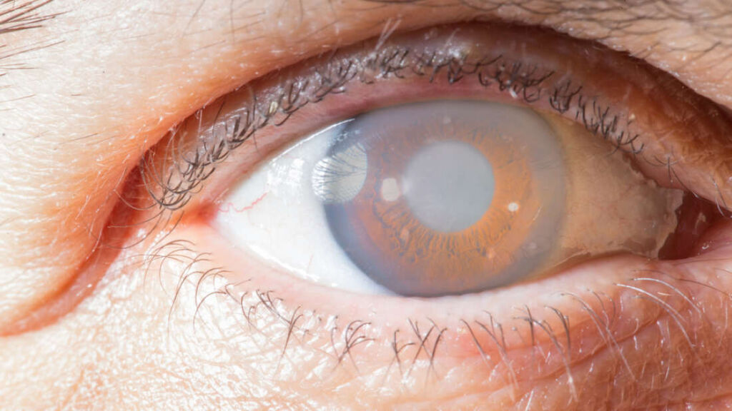 Primo trapianto di cornea artificiale al mondo, 78enne ritorna a vedere