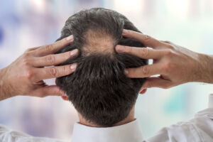 Alopecia androgenetica, sintomi e soluzioni per la perdita dei capelli
